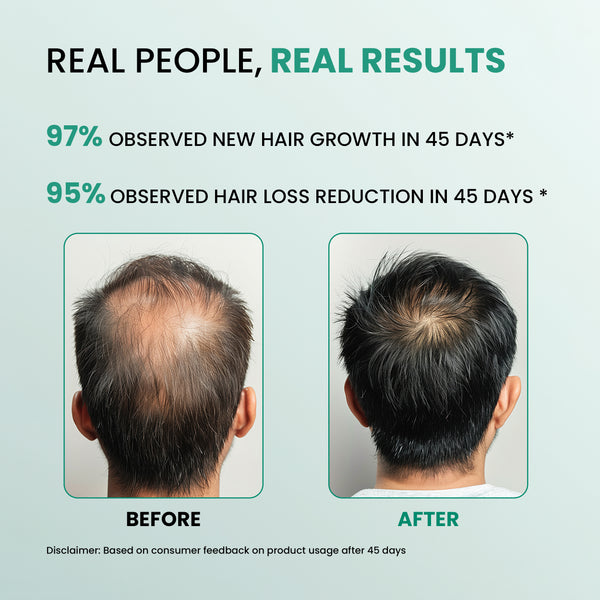 Dermalist Rosemary Advanced Hair Growth Serum Roll-On to Prevent Hairfall | Easy to Use(10 ml)