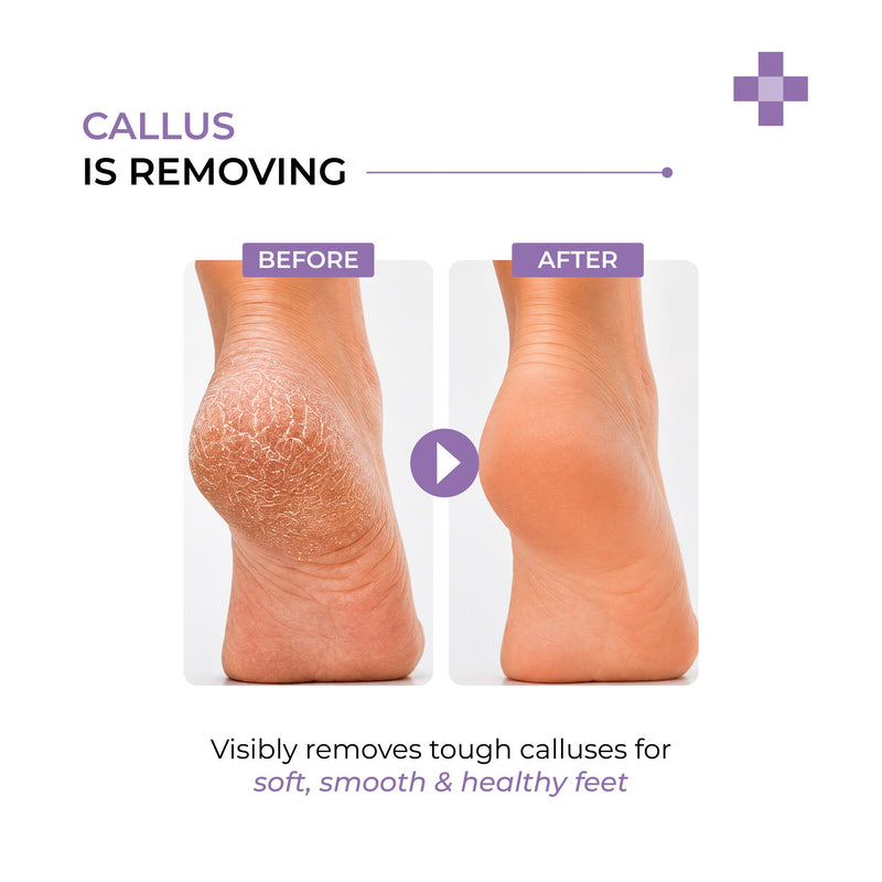 Dermalist Instant Callus Remover Spray for Feet |Foot  Callus Exfoliator For Hard, Rough & Dry Skin | One Step Pedicure Foot Care| Soft-looking Skin | 100ml